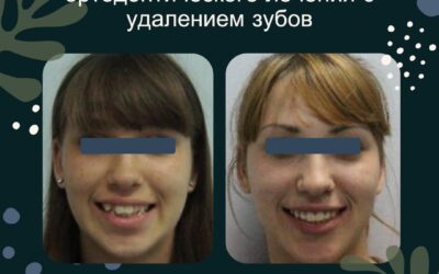 Обоснование выбора ортодонтического лечения с удалением зубов