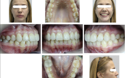 Коррекция дистальной окклюзии с применением микроимплантатов