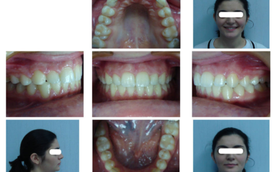 Дистализация верхних боковых зубов у взрослых пациентов с дистальной окклюзией зубных рядов с применением микроимлантатов.