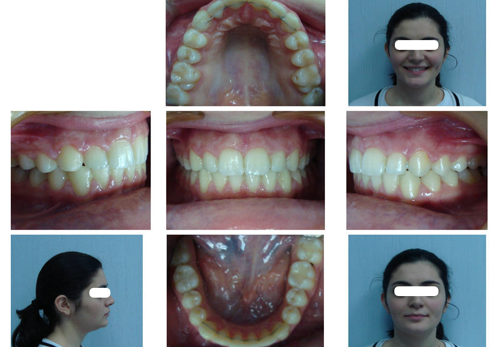 Дистализация верхних боковых зубов у взрослых пациентов с дистальной окклюзией зубных рядов с применением микроимлантатов.