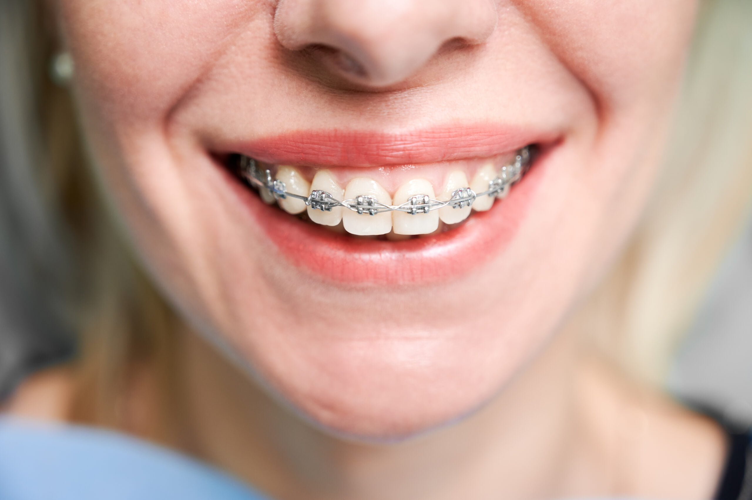 Smiling young woman with braces on teeth.