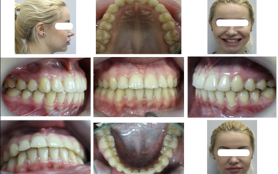 Лечение вертикальной резцовой дезокклюзии с применением микровинтов