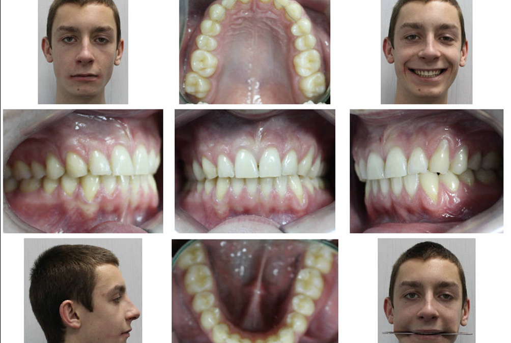 Сorrection of the canting maxillary occlusal plane with miniscrews.