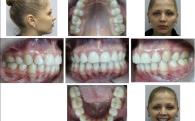 Bimaxillary Protrusion Treatment using Microscrew implants