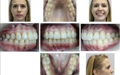 Class II Correction with Microscrews Implants