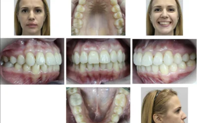 Class II Correction with Microscrews Implants